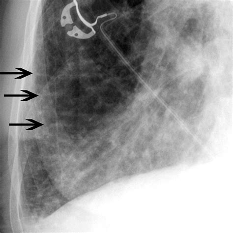 Heart Failure (HF) - Cardiovascular Disorders - MSD Manual Professional Edition