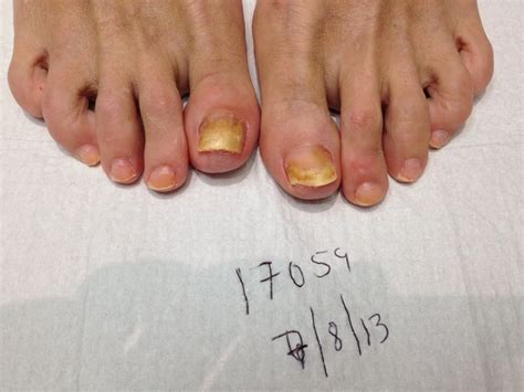 Toenail Fungus Before and After Photos - Advanced Podiatry of Manhasset, Huntington, Coram ...