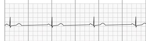 [最も欲しかった] sinus bradycardia with sinus arrhythmia 116016-Sinus bradycardia with sinus arrhythmia