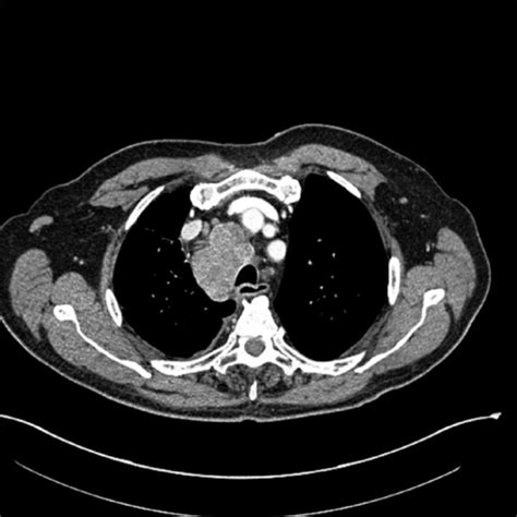 CT image of chest showing right hilar mass and enlarged | Open-i