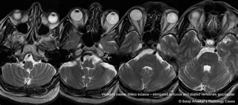 Dr Balaji Anvekar FRCR: Vertebrobasilar dolichoectasia