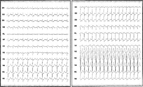 Left: 12 lead ECG of AVNRT with visible retrograde P wave in a woman of... | Download Scientific ...