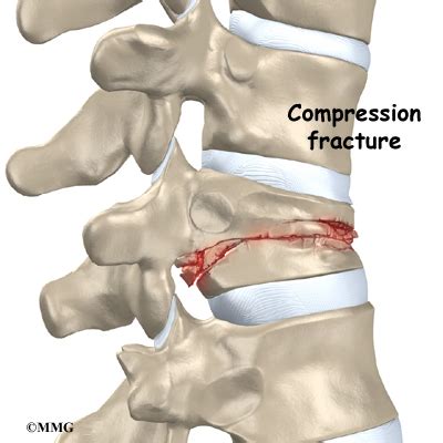 Vertebroplasty Procedure | Houston Methodist