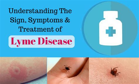 How to Know You Have Lyme Disease: Signs, Symptoms & Its Treatment