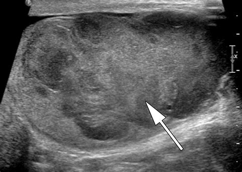 Testicular Seminoma and Its Mimics: From the Radiologic Pathology ...