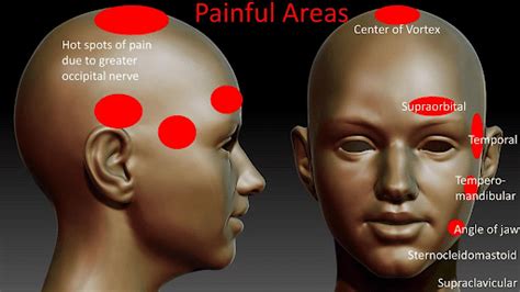 What is Occipital Neuralgia and can Upper Cervical Chiropractic help? | Top Chiropractic