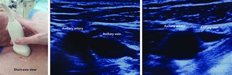 2D Ultrasound Image of the Right Axillary Vein and Artery in Short-Axis ...