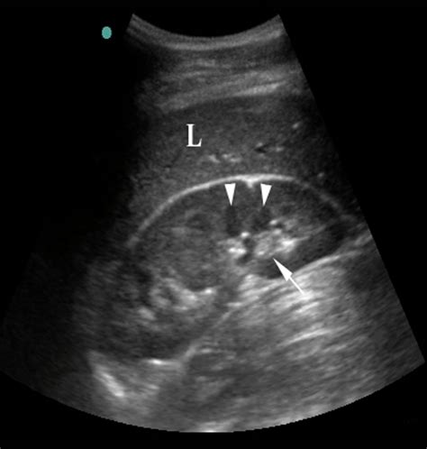 Renal Images | Emergency Ultrasonography