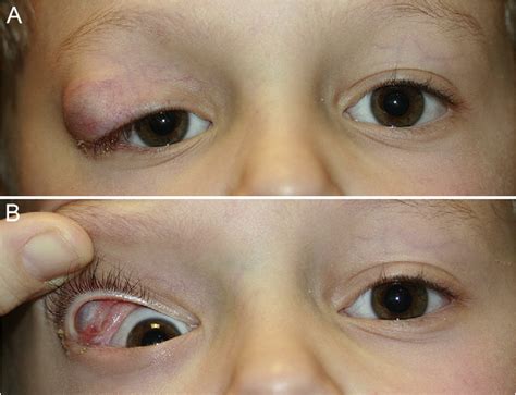 Developmental conjunctival cyst of the eyelid in a child. | Semantic ...