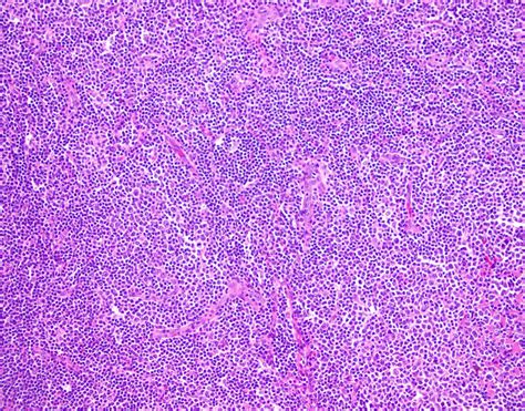 Follicular Lymphoma Pathology Outlines