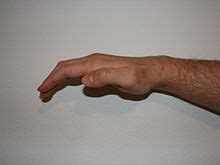 Ape hand deformity / Median nerve palsy | Hands, Deformed, Nerve palsy