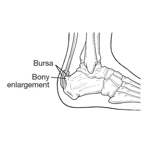 Haglund's Deformity - Sun Valley Foot & Ankle