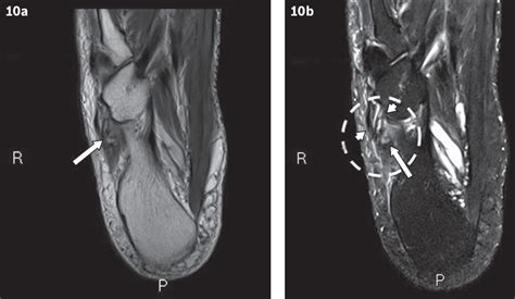 Common accessory ossicles of the foot: imaging features, pitfalls and associated pathology | SMJ