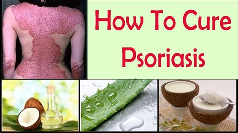 Psoriasis: 17 Natural Home Remedies