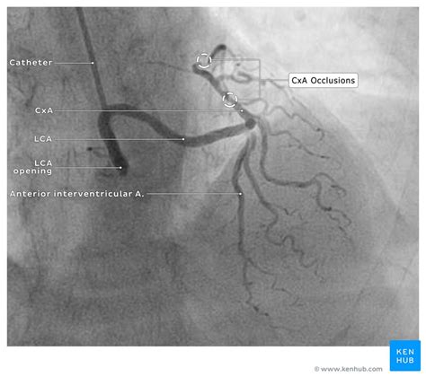 Coronary Angiogram Anatomy - Anatomical Charts & Posters