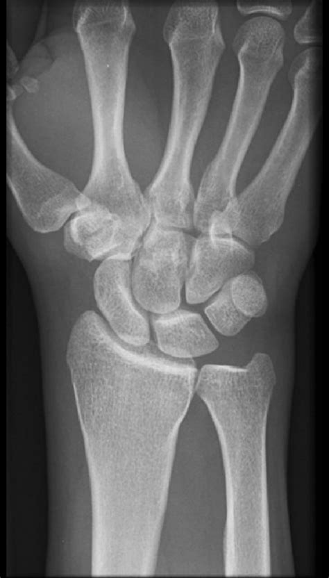 How to Read Wrist Xrays - Ortho Conditioning