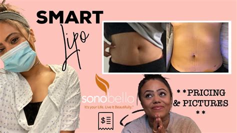 I GOT SMART LIPO WITH SONO BELLO! BEFORE & AFTER PICS [PART ONE] - YouTube