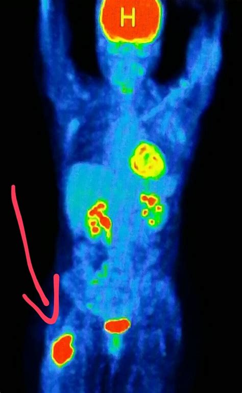 Is Cancer a Mitochondrial Disease? | Josh Mitteldorf