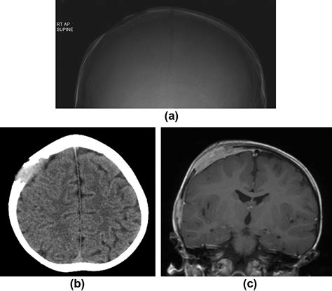 Imaging of focal calvarial lesions - Clinical Radiology