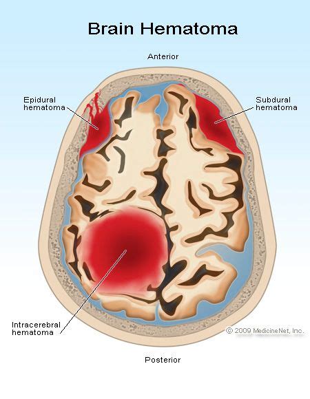 How To Spot A Stroke | Brain hemorrhage, Medical anatomy, Brain anatomy