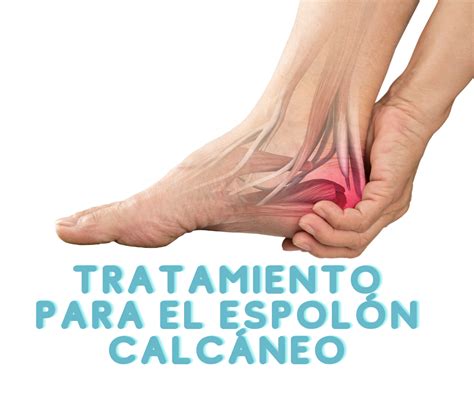 ¿Qué es el espolón calcáneo? - AD Fisioterapia Valencia