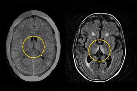 Wernicke–Korsakoff Syndrome (WKS) | Ausmed