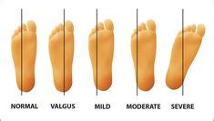 metatarsus adductus | Metatarsus Varus - this term usually refers to ...