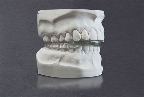 SRS Splint (Superior Repositioning Splint) – Dental Arts Laboratories, Inc.