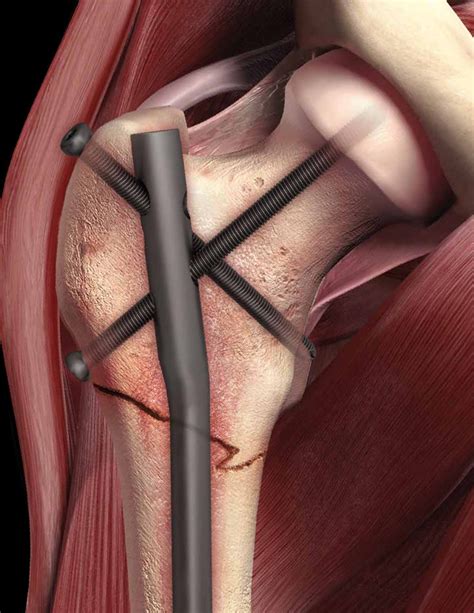 Versa Nail Femoral Troch Surgical Technique