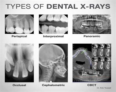 #dental #types #xrays #ofTypes of dental x-rays #DentalHygienistCup #dentalfacts #dental #types ...