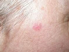 Basal cell carcinoma - if you have any concerns please get it checked out