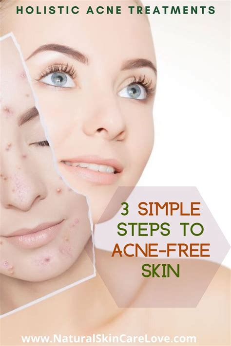 Holistic Acne Treatments | 3 Easy Steps For Radiant Skin | Holistic acne treatment, Acne ...