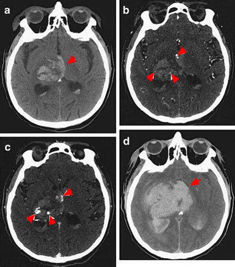 Intracranial Hemorrhage - Cause, Symptoms, Diagnosis, Treatment