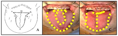 Life | Free Full-Text | The Efficacy of the Partial Glossectomy for Prevention of Airway Volume ...