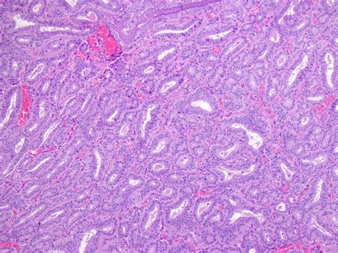 Pathology Outlines - Endometrioid carcinoma