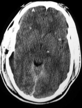 Diffuse Axonal Injury Imaging: Overview, Radiography, Computed Tomography