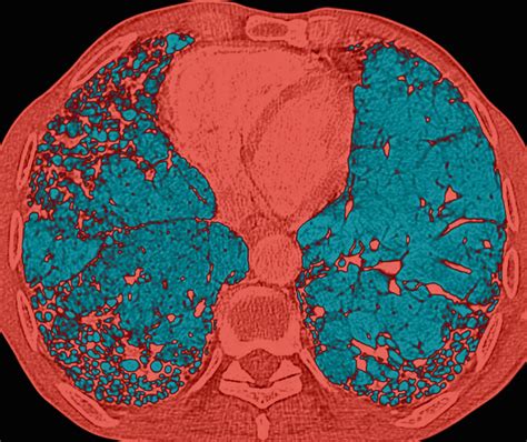 CT Honeycombing in Interstitial Lung Disease Linked to Higher Mortality Rates - Pulmonology Advisor