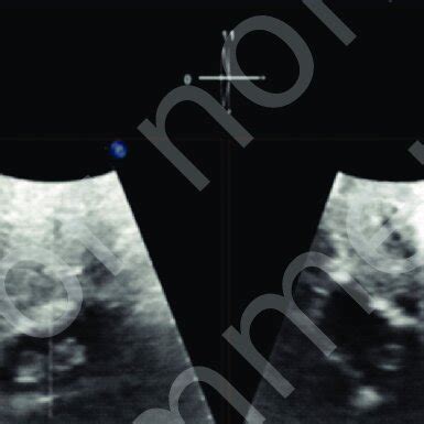 Transthoracic echocardiogram, substernal view -renal cell carcinoma... | Download Scientific Diagram