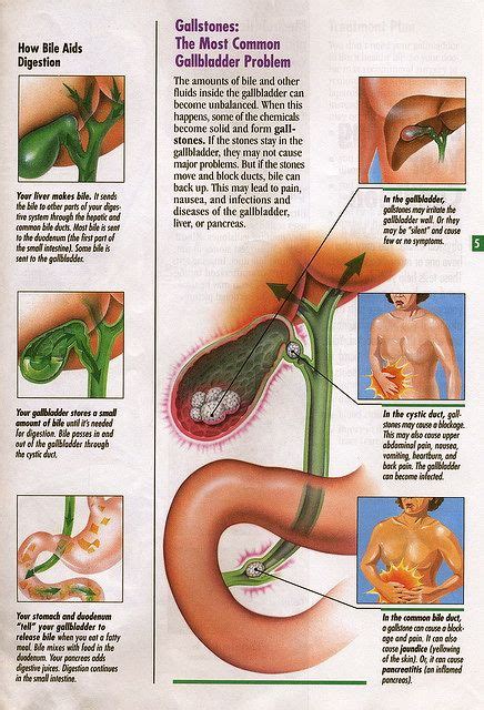 12 best gallbladder pain relief images on Pinterest | Pain relief, Gallbladder attack relief and ...