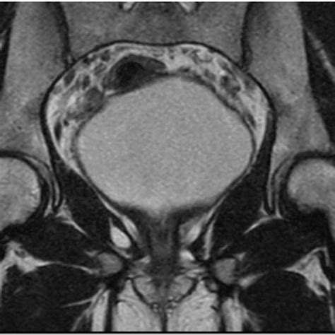 CT-scan and 3D reconstruction showing L1 hemivertebrae with anterior ...