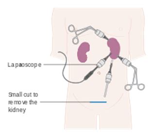 Kidney cancer surgery - Shyam Urosurgical Hospital