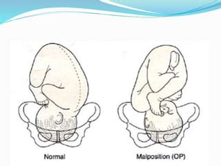 Occipito posterior positition | PPT