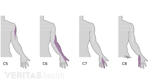 C7 Dermatome Mapneck And Arm Pain Spines Dorset - Printable Lab