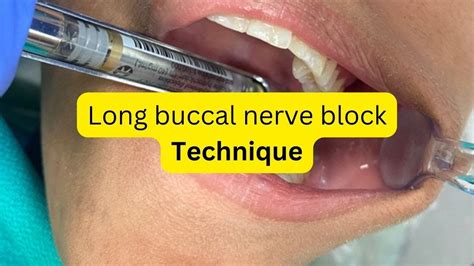 Buccal Nerve Block