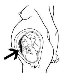 Placenta problems | The Royal Women's Hospital