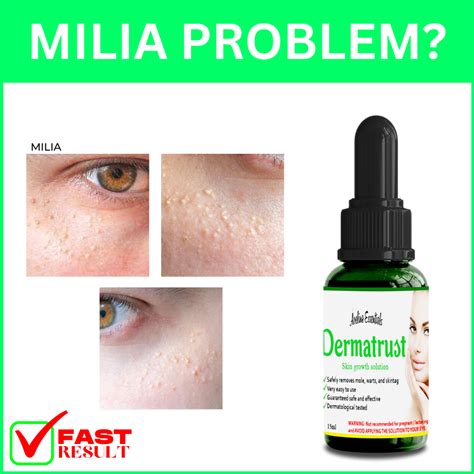 DERMATRUST MILIA REMOVER Skin Growth Remover , milia remover , milia remover original cream ...