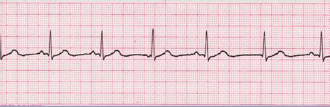 Wandering Atrial Pacemaker - EKG Lesson #312