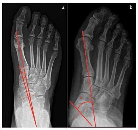 Z Foot Deformity