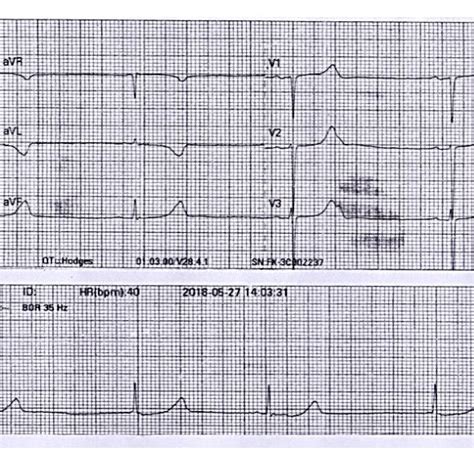 b): The subsequent ECG showing tall tented T waves with absent P waves,... | Download Scientific ...