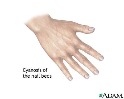 Cyanosis of the nail bed: MedlinePlus Medical Encyclopedia Image